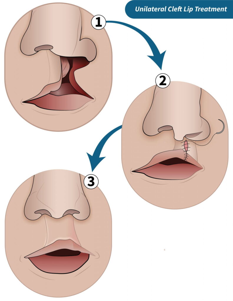 unilateral cleft lip treatment 791x1024